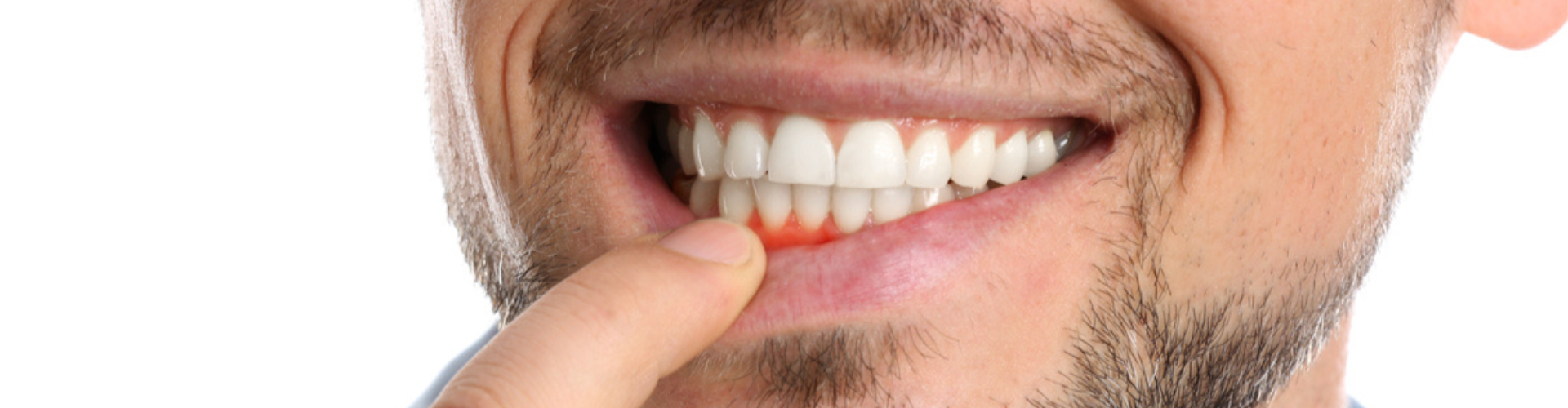 Close-up of a man smiling while pulling down his lip to show his irritated gums.